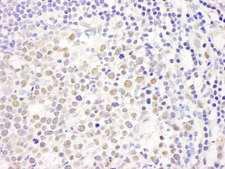 CHAF1A / CAF1 Antibody - Detection of Human Caf1p150 by Immunohistochemistry. Sample: FFPE section of human colon carcinoma Peyer's patch. Antibody: Affinity purified rabbit anti-Caf1p150 used at a dilution of 1:200 (1 ug/ml).
