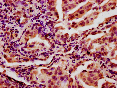 CHAF1A / CAF1 Antibody - Immunohistochemistry Dilution at 1:400 and staining in paraffin-embedded human lung cancer performed on a Leica BondTM system. After dewaxing and hydration, antigen retrieval was mediated by high pressure in a citrate buffer (pH 6.0). Section was blocked with 10% normal Goat serum 30min at RT. Then primary antibody (1% BSA) was incubated at 4°C overnight. The primary is detected by a biotinylated Secondary antibody and visualized using an HRP conjugated SP system.