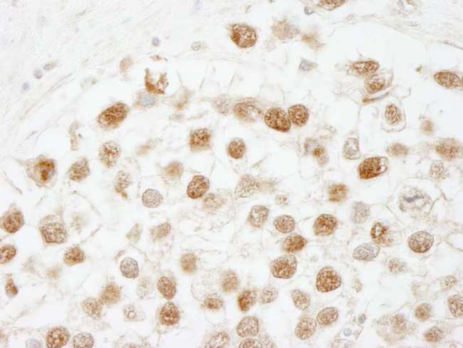 CHAF1B / CAF1 Antibody - Detection of Human CAF-1 p60 by Immunohistochemistry. Sample: FFPE section of human seminoma. Antibody: Affinity purified rabbit anti-CAF-1 p60 used at a dilution of 1:250.