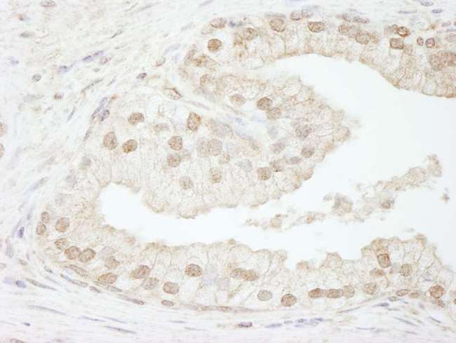 CHAF1B / CAF1 Antibody - Detection of Human CAF-1 p60 by Immunohistochemistry. Sample: FFPE section of human prostate carcinoma. Antibody: Affinity purified rabbit anti-CAF-1 p60 used at a dilution of 1:250.