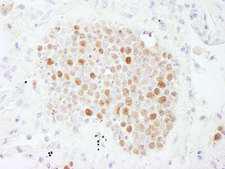 CHAF1B / CAF1 Antibody - Detection of Human CAF-1 p60 by Immunohistochemistry. Sample: FFPE section of human small cell lung cancer. Antibody: Affinity purified rabbit anti-CAF-1 p60 used at a dilution of 1:200 (1 ug/ml).