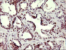 CHAF1B / CAF1 Antibody - IHC of paraffin-embedded Carcinoma of Human prostate tissue using anti-CHAF1B mouse monoclonal antibody. (Heat-induced epitope retrieval by 10mM citric buffer, pH6.0, 120°C for 3min).