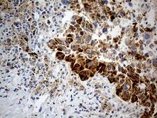 CHCHD10 Antibody - Immunohistochemical staining of paraffin-embedded Carcinoma of Human lung tissue using anti-CHCHD10 mouse monoclonal antibody. (Heat-induced epitope retrieval by 1mM EDTA in 10mM Tris buffer. (pH8.5) at 120°C for 3 min. (1:500)