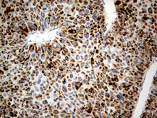 CHCHD10 Antibody - Immunohistochemical staining of paraffin-embedded Carcinoma of Human liver tissue using anti-CHCHD10 mouse monoclonal antibody. (Heat-induced epitope retrieval by 1mM EDTA in 10mM Tris buffer. (pH8.5) at 120°C for 3 min. (1:500)