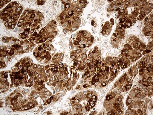 CHCHD10 Antibody - Immunohistochemical staining of paraffin-embedded Carcinoma of Human liver tissue using anti-CHCHD10 mouse monoclonal antibody. (Heat-induced epitope retrieval by 1mM EDTA in 10mM Tris buffer. (pH8.5) at 120°C for 3 min. (1:500)