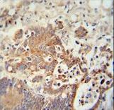 CHCHD2 Antibody - CHCHD2 antibody immunohistochemistry of formalin-fixed and paraffin-embedded human colon carcinoma followed by peroxidase-conjugated secondary antibody and DAB staining.