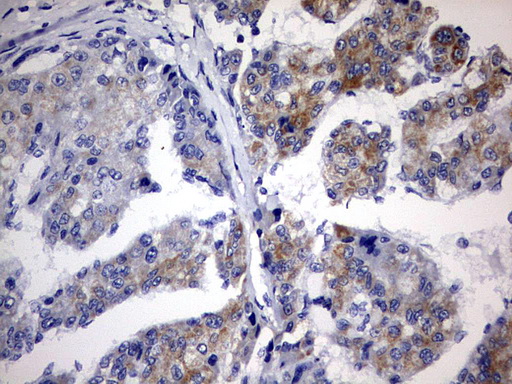 CHCHD3 Antibody - IHC of paraffin-embedded Carcinoma of Human liver tissue using anti-CHCHD3 mouse monoclonal antibody. (Heat-induced epitope retrieval by 10mM citric buffer, pH6.0, 120°C for 3min).