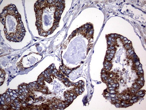 CHCHD3 Antibody - IHC of paraffin-embedded Human prostate tissue using anti-CHCHD3 mouse monoclonal antibody. (Heat-induced epitope retrieval by 1 mM EDTA in 10mM Tris, pH9.0, 120°C for 3min).
