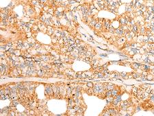 CHCHD3 Antibody - Immunohistochemistry of paraffin-embedded Human gastric cancer tissue  using CHCHD3 Polyclonal Antibody at dilution of 1:45(×200)