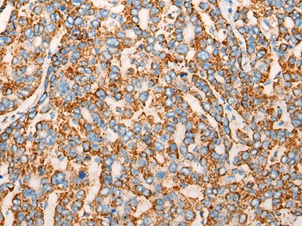 CHCHD3 Antibody - Immunohistochemistry of paraffin-embedded Human liver cancer tissue  using CHCHD3 Polyclonal Antibody at dilution of 1:45(×200)