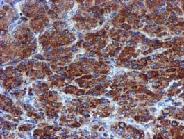 CHCHD5 Antibody - IHC of paraffin-embedded Carcinoma of Human liver tissue using anti-CHCHD5 mouse monoclonal antibody.
