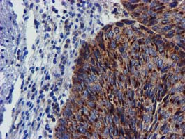 CHCHD5 Antibody - IHC of paraffin-embedded Carcinoma of Human bladder tissue using anti-CHCHD5 mouse monoclonal antibody.