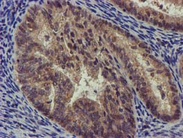CHCHD5 Antibody - IHC of paraffin-embedded Adenocarcinoma of Human endometrium tissue using anti-CHCHD5 mouse monoclonal antibody.