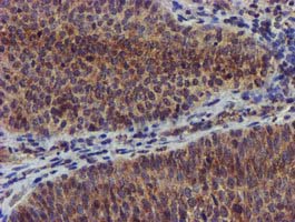 CHCHD5 Antibody - IHC of paraffin-embedded Carcinoma of Human bladder tissue using anti-CHCHD5 mouse monoclonal antibody.