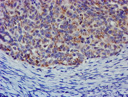 CHCHD5 Antibody - IHC of paraffin-embedded Adenocarcinoma of Human ovary tissue using anti-CHCHD5 mouse monoclonal antibody.