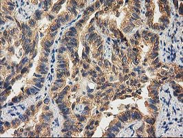 CHCHD5 Antibody - IHC of paraffin-embedded Carcinoma of Human lung tissue using anti-CHCHD5 mouse monoclonal antibody. (Heat-induced epitope retrieval by 10mM citric buffer, pH6.0, 100C for 10min).