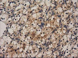 CHCHD5 Antibody - IHC of paraffin-embedded Carcinoma of Human kidney tissue using anti-CHCHD5 mouse monoclonal antibody. (Heat-induced epitope retrieval by 10mM citric buffer, pH6.0, 100C for 10min).