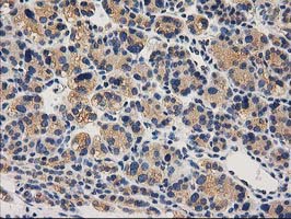 CHCHD5 Antibody - IHC of paraffin-embedded Carcinoma of Human thyroid tissue using anti-CHCHD5 mouse monoclonal antibody. (Heat-induced epitope retrieval by 10mM citric buffer, pH6.0, 100C for 10min).