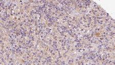 CHCHD6 Antibody - 1:100 staining human lymph carcinoma tissue by IHC-P. The sample was formaldehyde fixed and a heat mediated antigen retrieval step in citrate buffer was performed. The sample was then blocked and incubated with the antibody for 1.5 hours at 22°C. An HRP conjugated goat anti-rabbit antibody was used as the secondary.