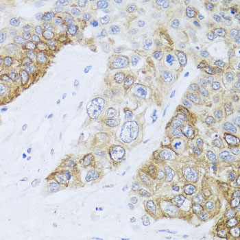 CHD1 Antibody - Immunohistochemistry of paraffin-embedded human lung cancer tissue.