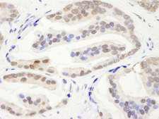 CHD3 Antibody - Detection of Human CHD3 by Immunohistochemistry. Sample: FFPE section of human prostate carcinoma. Antibody: Affinity purified rabbit anti-CHD3 used at a dilution of 1:250.