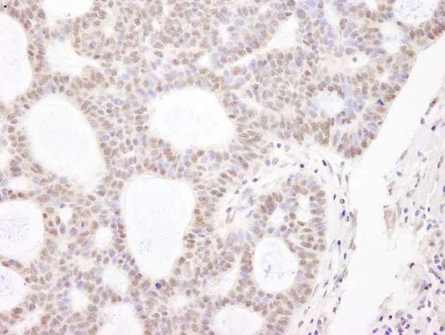 CHD3 Antibody - Detection of Human CHD3 by Immunohistochemistry. Sample: FFPE section of human basal cell carcinoma. Antibody: Affinity purified rabbit anti-CHD3 used at a dilution of 1:250.