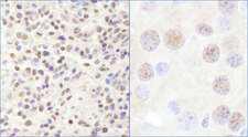 CHD3 Antibody - Detection of Human and Mouse CHD3 by Immunohistochemistry. Sample: FFPE section of human Ewing sarcoma (left) and mouse renal cell carcinoma (right). Antibody: Affinity purified rabbit anti-CHD3 used at a dilution of 1:1000 (1 ug/ml).