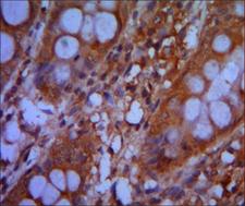 CHD3 Antibody - IHC of paraffin-embedded colon cancer tissues using CHD3 mouse monoclonal antibody with DAB staining.