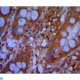 CHD3 Antibody - Immunohistochemistry (IHC) analysis of paraffin-embedded colon cancer tissues with DAB staining using Mi2-alpha Monoclonal Antibody.