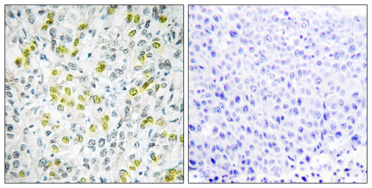 CHD4 Antibody - Immunohistochemistry analysis of paraffin-embedded human liver carcinoma tissue, using CHD4 Antibody. The picture on the right is blocked with the synthesized peptide.