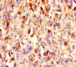CHD4 Antibody - Immunohistochemistry of paraffin-embedded human melanoma cancer at dilution of 1:100