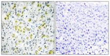 CHD4 Antibody - Peptide - + Immunohistochemistry analysis of paraffin-embedded human liver carcinoma tissue, using CHD4 antibody.