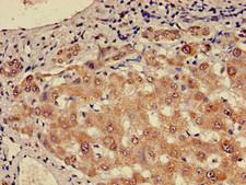 CHD5 Antibody - Immunohistochemistry of paraffin-embedded human liver cancer using CHD5 Antibody at dilution of 1:100