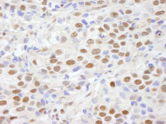 CHD8 Antibody - Detection of Human CHD8 by Immunohistochemistry. Sample: FFPE section of human breast carcinoma. Antibody: Affinity purified rabbit anti-CHD8 used at a dilution of 1:100.
