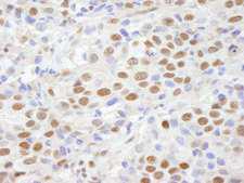CHD8 Antibody - Detection of Human CHD8 by Immunohistochemistry. Sample: FFPE section of human breast carcinoma. Antibody: Affinity purified rabbit anti-CHD8 used at a dilution of 1:100.