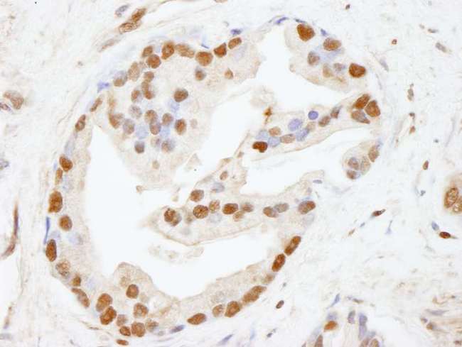 CHD8 Antibody - Detection of Human CHD8 by Immunohistochemistry. Sample: FFPE section of human prostate carcinoma. Antibody: Affinity purified rabbit anti-CHD8 used at a dilution of 1:100.