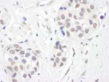CHD8 Antibody - Detection of Human CHD8 by Immunohistochemistry. Sample: FFPE section of human breast carcinoma. Antibody: Affinity purified rabbit anti-CHD8 used at a dilution of 1:200 (1 ug/ml).