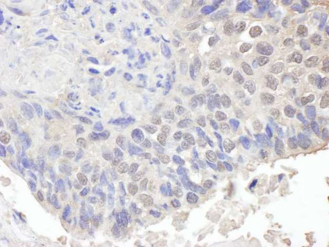 CHD8 Antibody - Detection of Human CHD8 by Immunohistochemistry. Sample: FFPE section of human ovarian carcinoma. Antibody: Affinity purified rabbit anti-CHD8 used at a dilution of 1:1000 (1 Detection: DAB.