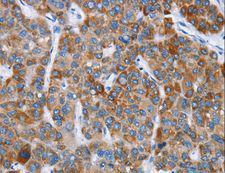 CHDH / CHD Antibody - Immunohistochemistry of paraffin-embedded Human liver cancer using CHDH Polyclonal Antibody at dilution of 1:20.