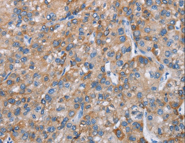 CHDH / CHD Antibody - Immunohistochemistry of paraffin-embedded Human liver cancer using CHDH Polyclonal Antibody at dilution of 1:25.
