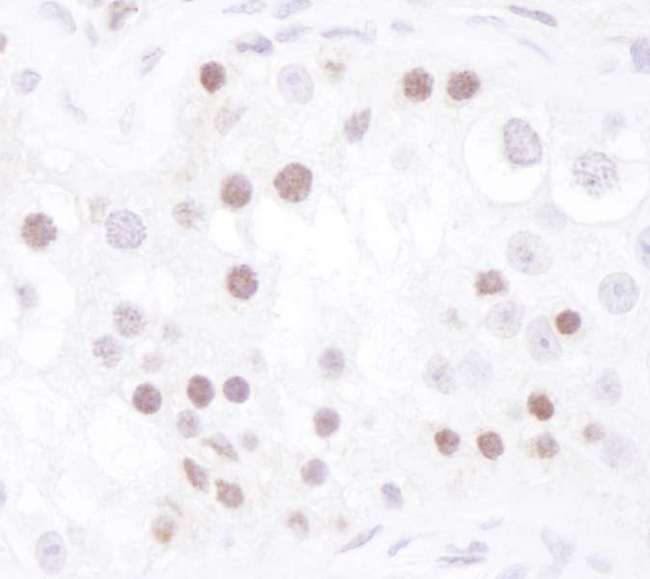 CHEK1 / CHK1 Antibody - Detection of Human Chk1 by Immunohistochemistry. Sample: FFPE section of human testicular seminoma. Antibody: Affinity purified rabbit anti-Chk1 used at a dilution of 1:1000 (1 ug/ml).