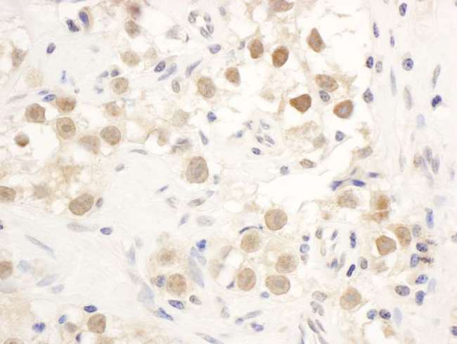 CHEK1 / CHK1 Antibody - Detection of human CHK1 by immunohistochemistry. Sample: FFPE section of human breast carcinoma. Antibody: Affinity purified rabbit anti-CHK1 used at a dilution of 1:1,000 (1µg/ml). Detection: DAB