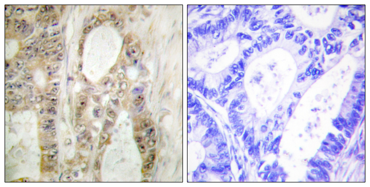 CHEK1 / CHK1 Antibody - Immunohistochemistry analysis of paraffin-embedded human colon carcinoma, using Chk1 Antibody. The picture on the right is blocked with the synthesized peptide.