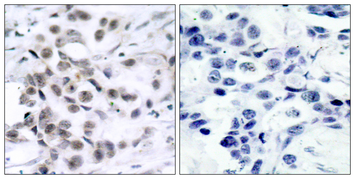 CHEK1 / CHK1 Antibody - Immunohistochemistry analysis of paraffin-embedded human breast carcinoma tissue, using Chk1 Antibody. The picture on the right is blocked with the synthesized peptide.