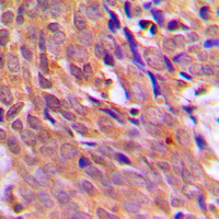 CHEK1 / CHK1 Antibody - Immunohistochemical analysis of CHK1 staining in human breast cancer formalin fixed paraffin embedded tissue section. The section was pre-treated using heat mediated antigen retrieval with sodium citrate buffer (pH 6.0). The section was then incubated with the antibody at room temperature and detected using an HRP conjugated compact polymer system. DAB was used as the chromogen. The section was then counterstained with hematoxylin and mounted with DPX.