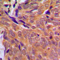 CHEK1 / CHK1 Antibody - Immunohistochemical analysis of CHK1 staining in human breast cancer formalin fixed paraffin embedded tissue section. The section was pre-treated using heat mediated antigen retrieval with sodium citrate buffer (pH 6.0). The section was then incubated with the antibody at room temperature and detected using an HRP conjugated compact polymer system. DAB was used as the chromogen. The section was then counterstained with hematoxylin and mounted with DPX.