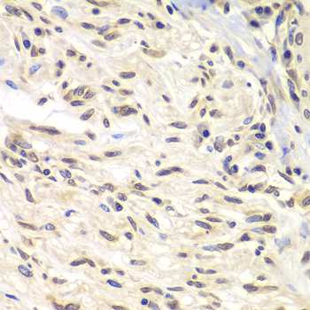 CHEK1 / CHK1 Antibody - Immunohistochemistry of paraffin-embedded human gastric cancer tissue.