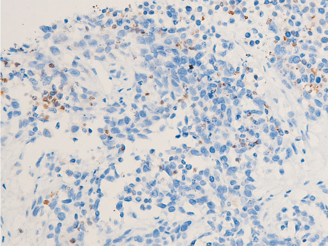 CHEK1 / CHK1 Antibody - 1:100 staining rat carcinoma tissue by IHC-P. The tissue was formaldehyde fixed and a heat mediated antigen retrieval step in citrate buffer was performed. The tissue was then blocked and incubated with the antibody for 1.5 hours at 22°C. An HRP conjugated goat anti-rabbit antibody was used as the secondary.