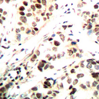 CHEK1 / CHK1 Antibody - Immunohistochemical analysis of CHK1 (pS296) staining in human breast cancer formalin fixed paraffin embedded tissue section. The section was pre-treated using heat mediated antigen retrieval with sodium citrate buffer (pH 6.0). The section was then incubated with the antibody at room temperature and detected using an HRP conjugated compact polymer system. DAB was used as the chromogen. The section was then counterstained with hematoxylin and mounted with DPX.