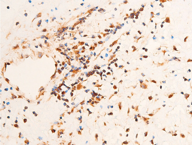 CHEK1 / CHK1 Antibody - 1:100 staining human glioma tissue by IHC-P. The tissue was formaldehyde fixed and a heat mediated antigen retrieval step in citrate buffer was performed. The tissue was then blocked and incubated with the antibody for 1.5 hours at 22°C. An HRP conjugated goat anti-rabbit antibody was used as the secondary.